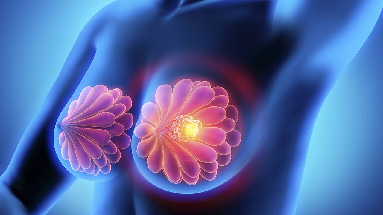 , &iquest;Sabes cu&aacute;l es tu riesgo de desarrollar c&aacute;ncer de mama?, Grupo Residencial